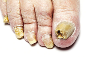 Why Do Toenails Fall Off? Learn More About Why Your Toenails Do This!