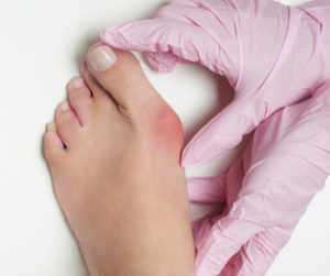 Bunions and What They Are