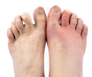 Gout and What That Is