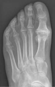 Hallux Rigidus for Blog Post